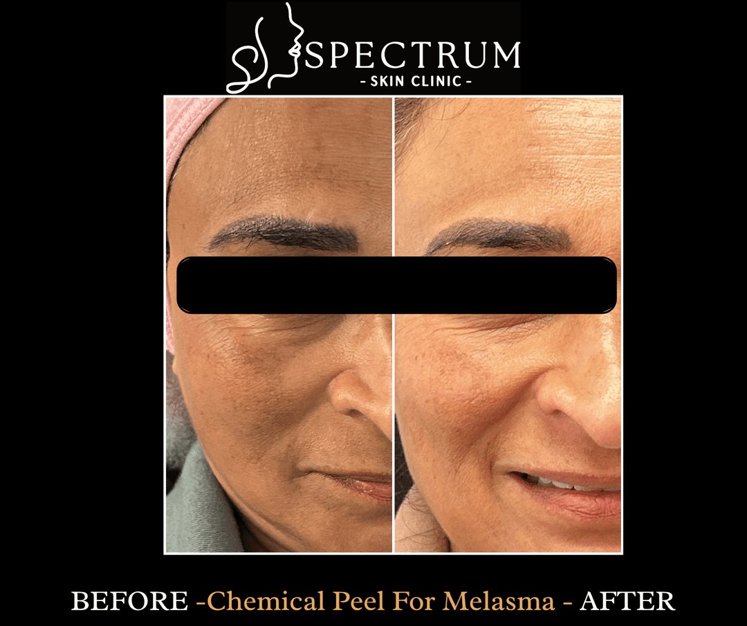 Chemical Peel for Melasma