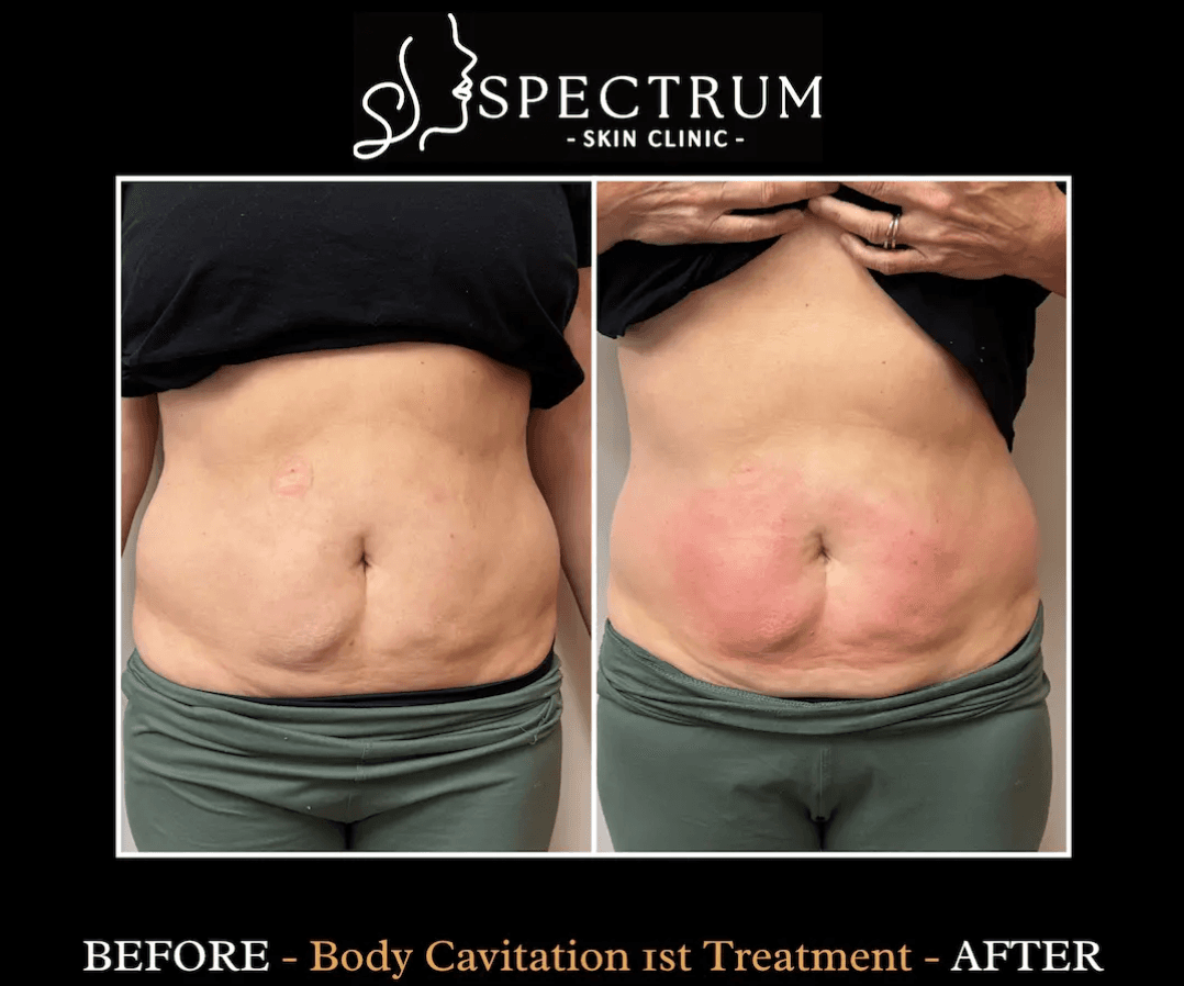 Body Cavitation