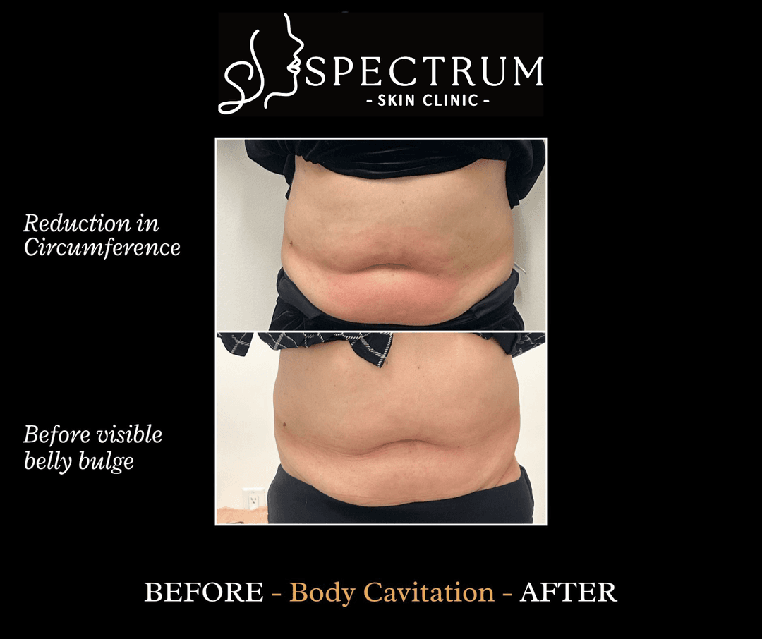 Body Cavitation