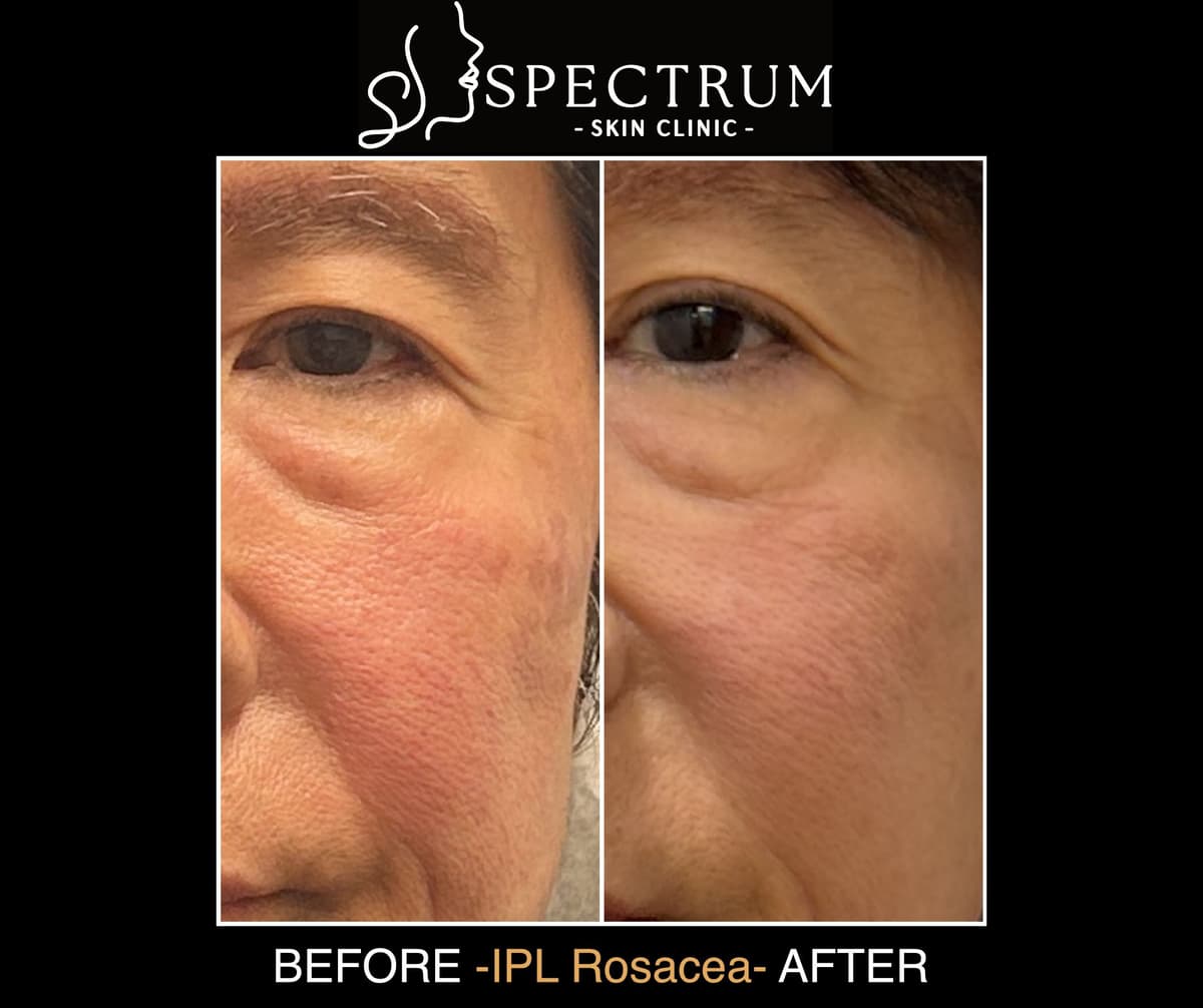 Who Benefits Most From IPL for Rosacea